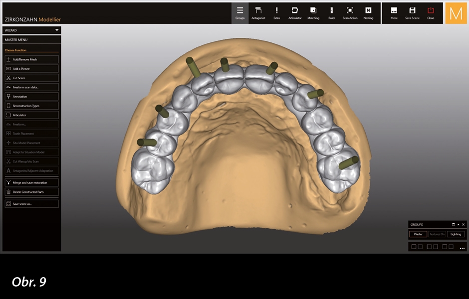 Značný vestibulární sklon implantátů – technika Double Screw umožňuje vyhnout se neestetickému umístění přístupových otvorů pro šroubky.