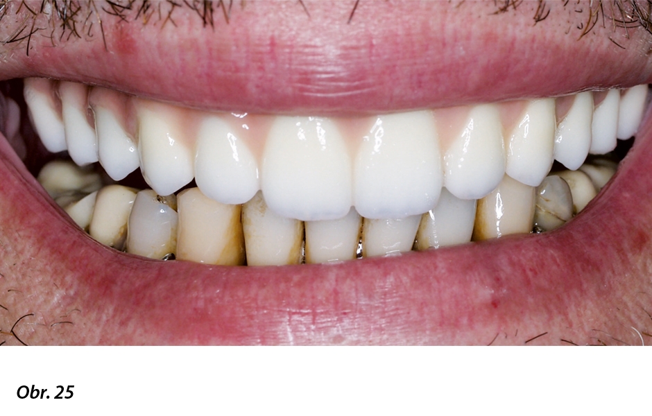 Definitivní horní náhrada in situ zhotovená s ohledem na naplánovanou náhradu celého zubního oblouku v dolní čelisti v druhé fázi ošetření.