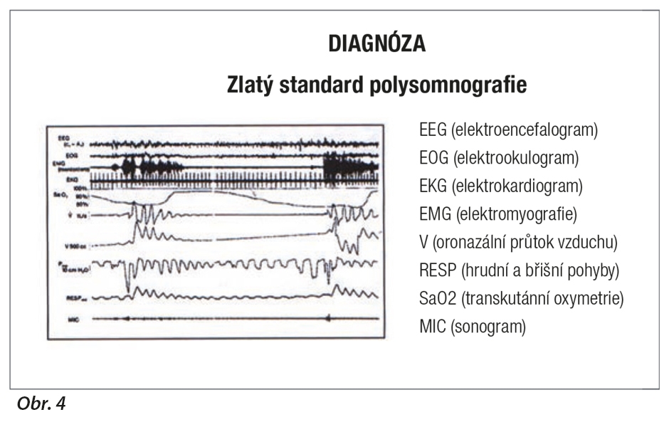 Zlatý standard v diagnostice OSAS: polysomnografie