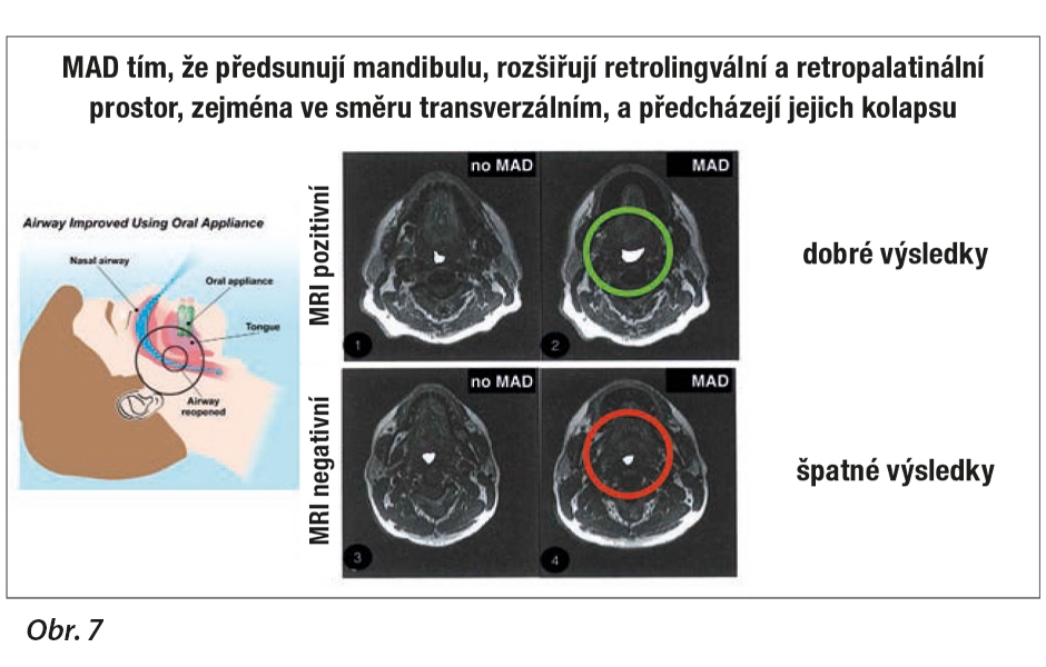 Mechanismus účinku MAD v retrolingválním a retropalatinálním prostoru