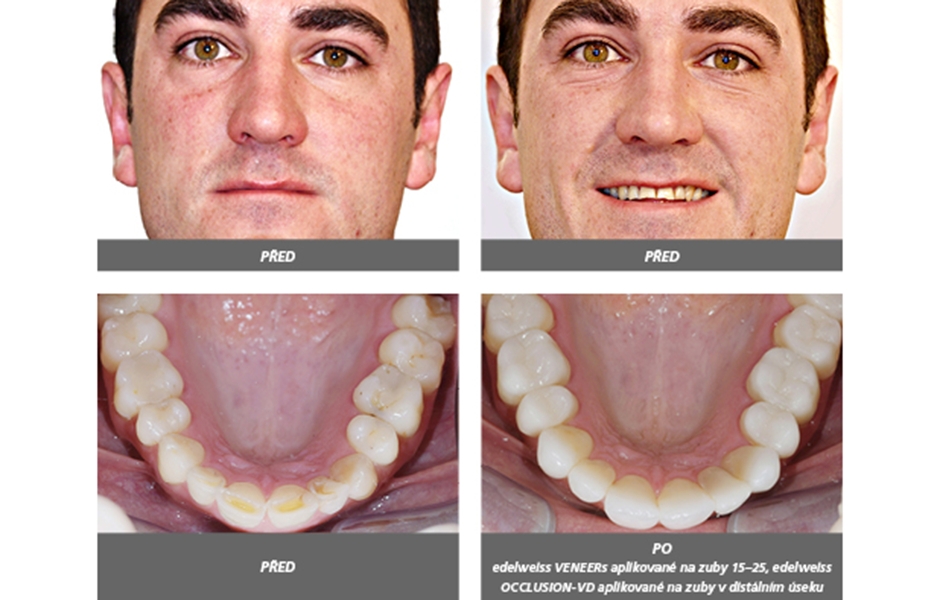 Úprava vertikálního rozměru pomocí edelweiss VENEER a OCCLUSION-VD