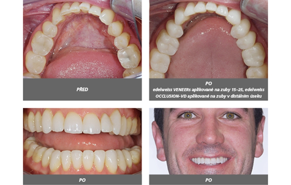 Úprava vertikálního rozměru pomocí edelweiss VENEER a OCCLUSION-VD