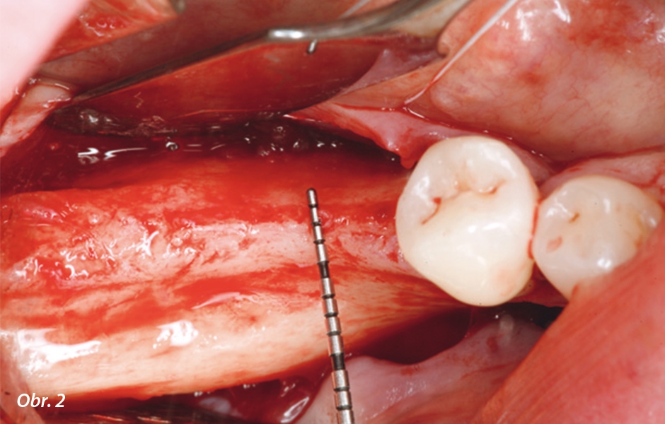 Okluzální pohled na tenký hřeben v distální části dolní čelisti. V oblasti keratinizované gingivy na středu hřebenu byl proveden mukoperiostální řez. 