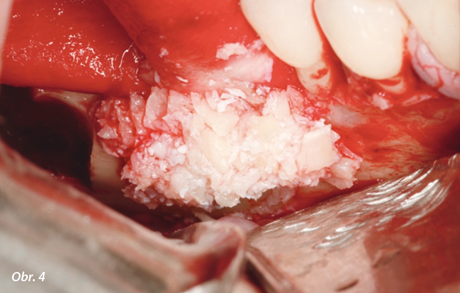 Bukální pohled po umístění směsi autogenní granulované kosti a granulí Geistlich Bio-Oss v poměru 1 : 1. 