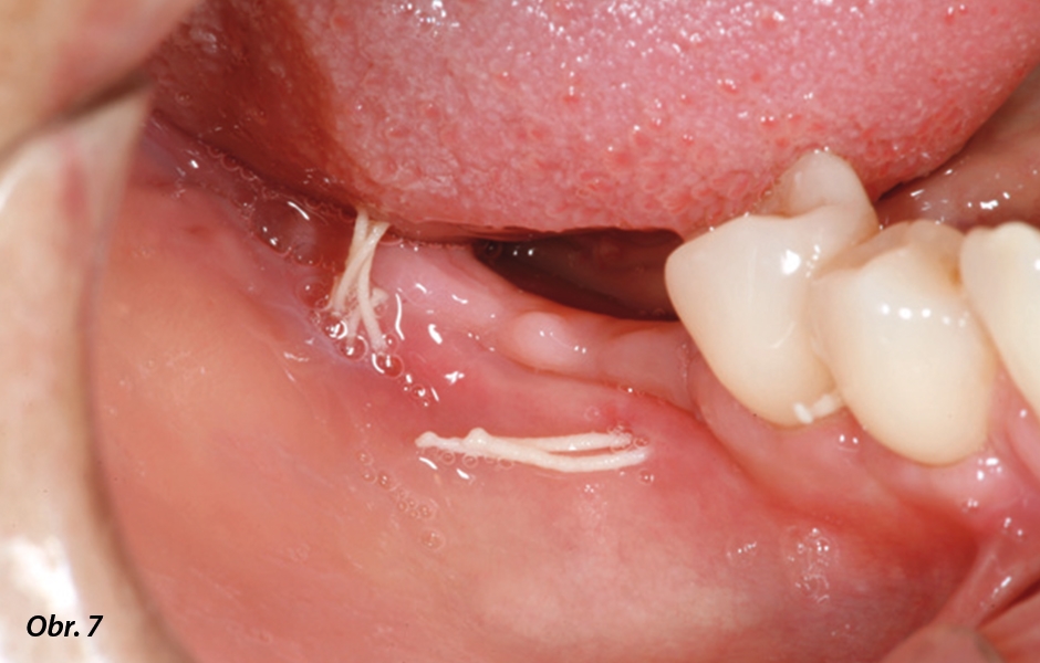 Bukální pohled na měkké tkáně po třech týdnech bezproblémového hojení.