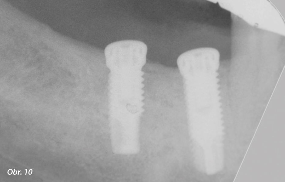 Periapikální RTG snímek při zavádění implantátu.