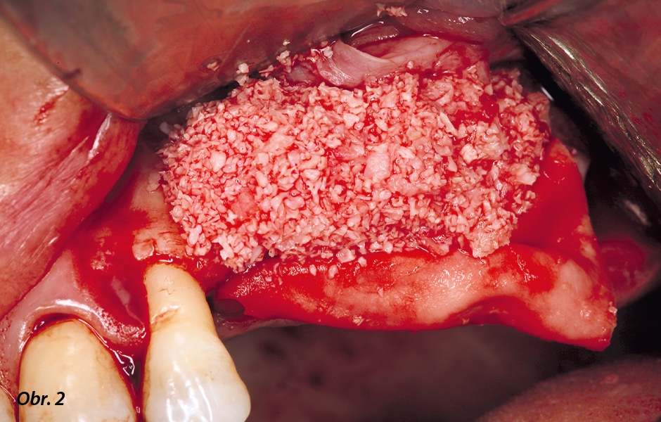 Aplikace směsi autologní kosti a materiálu Geistlich Bio-Oss v poměru 1 : 1.