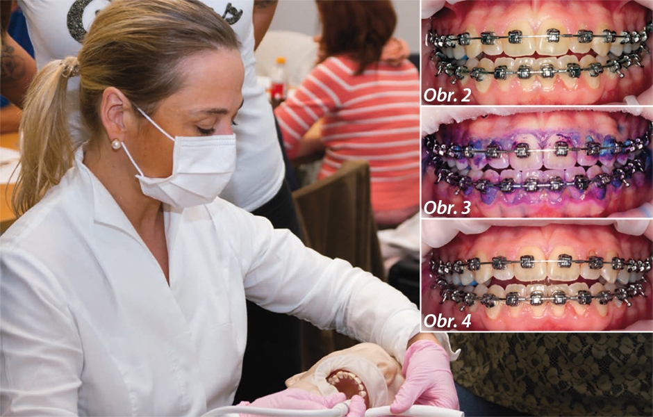 Obr. 2: Před Guided Biofilm Therapy–biofilm je viditelný pouze částečně, Obr. 3: Barvení pomocí Mira-2-Ton (Hager & Werken) – zabarvení před vyčištěním horních a dolních zubů, Obr. 4: Kontrola po vyčištění horních a dolních zubů za použití moderních metod