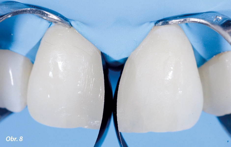 Byly použity matrice v kontrastních barvách. Matrice pomohla udržet na místě kapku nevytvrzeného zatékavého kompozitu mezi každou matricí a zubem.