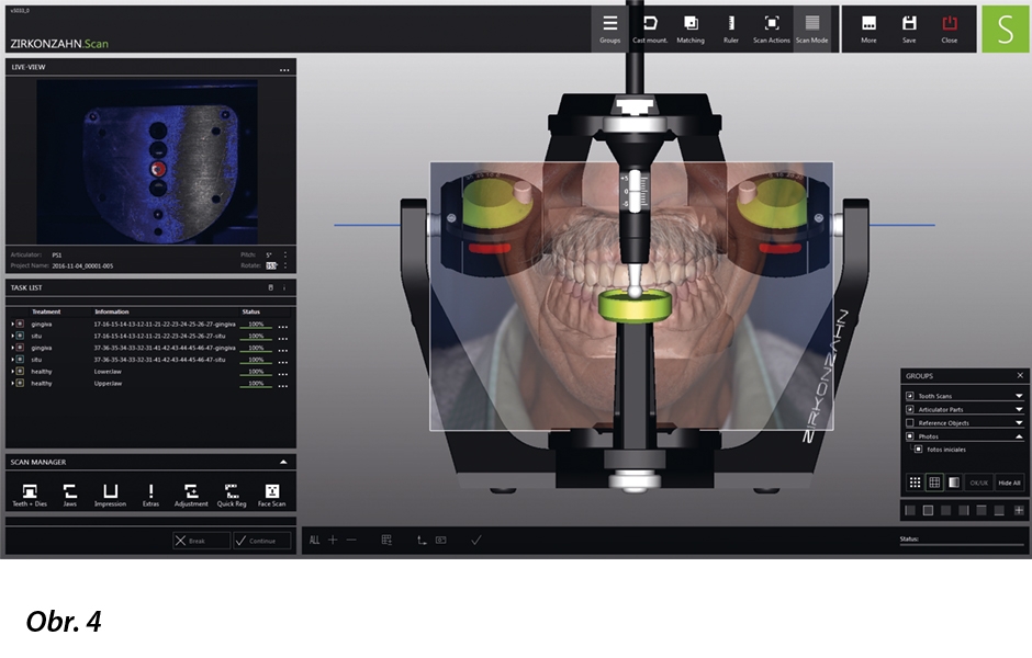 Nastavení individuálních parametrů konkrétního pacienta v programu Zirkonzahn.Archiv. V něm uložené údaje se importují do programu Zirkonzahn.Scan a dojde k fúzi dat.