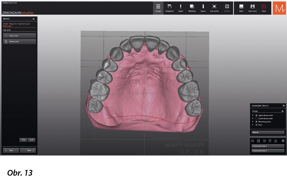 Stavění zubů (přirozený set zubů ze zubní knihovny Heroes Collection firmy Zirkonzahn; tvar zubů „Aida“). Zobrazení kořenových částí zvolených zubů dovoluje v CAD programu jejich anatomicky správné umístění…