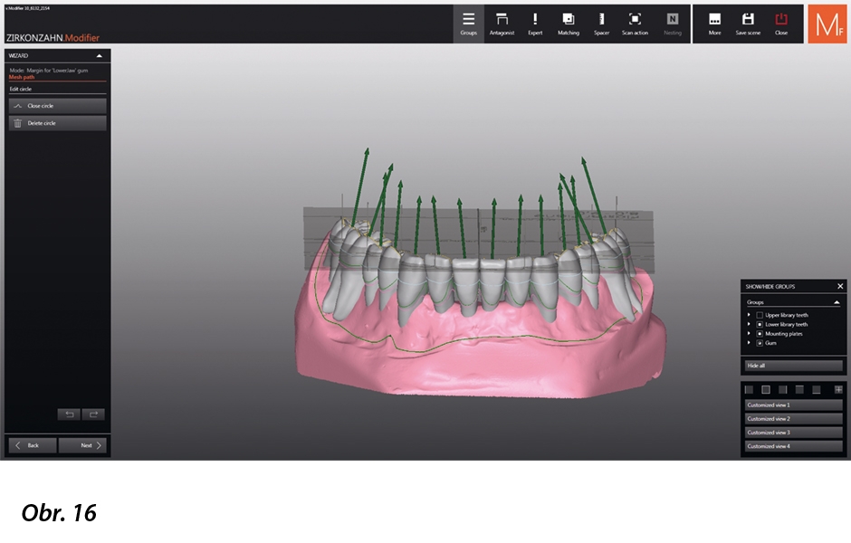Stavění zubů (přirozený set zubů ze zubní knihovny Heroes Collection firmy Zirkonzahn; tvar zubů „Aida“). Zobrazení kořenových částí zvolených zubů dovoluje v CAD programu jejich anatomicky správné umístění…