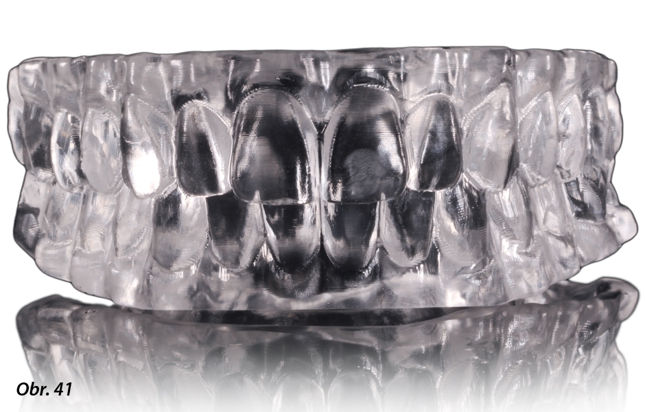 Vzhledem k nově definované poloze skusu byla pomocí CAD/CAM vyfrézována z materiálu Therapon Transpa skusová šablona ke kontrole v ústech pacienta. 