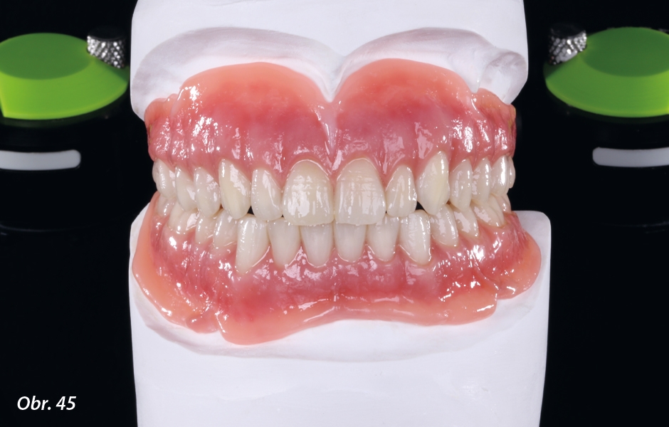 Vyfrézované jednotlivé zuby byly následně lepeny (Polibond, Zirkonzahn) na báze dolní a horní náhrady, rovněž vyfrézované metodou CAD/CAM. Báze náhrad byly dále esteticky individualizovány pomocí gingiválních kompozitů Zirkonzahn.