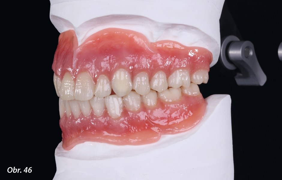 Vyfrézované jednotlivé zuby byly následně lepeny (Polibond, Zirkonzahn) na báze dolní a horní náhrady, rovněž vyfrézované metodou CAD/CAM. Báze náhrad byly dále esteticky individualizovány pomocí gingiválních kompozitů Zirkonzahn.