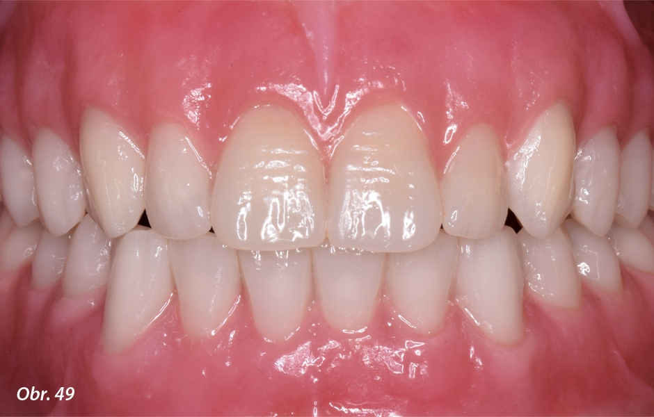 Po nasazení nových náhrad do úst pacienta byl patrný excelentní estetický i funkční výsledek.