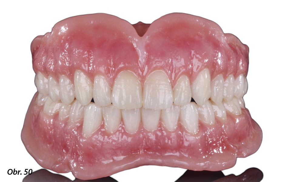 Po nasazení nových náhrad do úst pacienta byl patrný excelentní estetický i funkční výsledek.