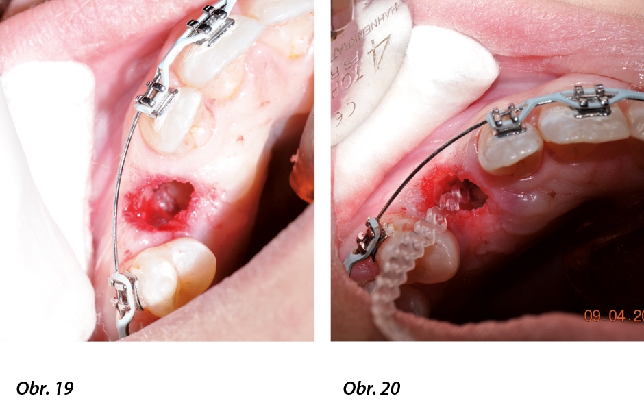 Minimálně invazivní chirurgie v dětské  stomatologii za použití stomatologických laserů