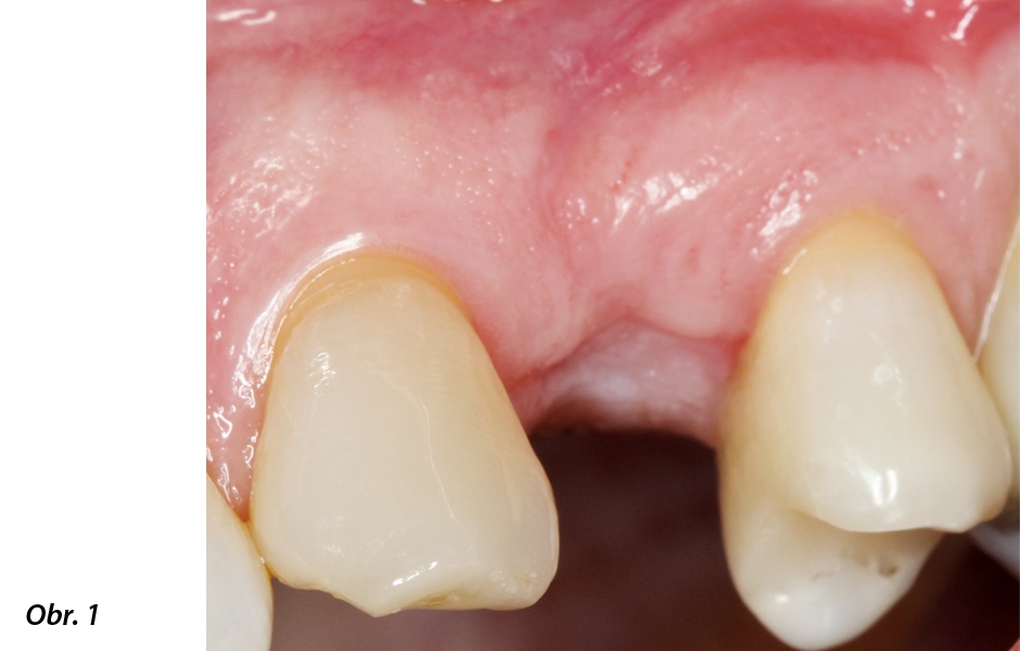Počáteční diagnóza: 53letý pacient požaduje nahrazení chybějícího zubu 24 implantátem.