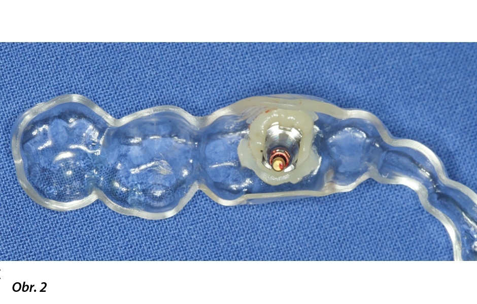 Zubní lékař používá vakuově vytvořenou šablonu a kompozit pro registraci polohy implantátu po implantaci (skusový registrát).