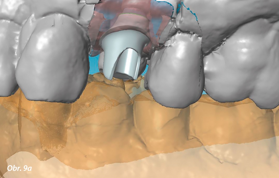 Ve frézovacím centru jsou modely skenovány a pomocí softwaru CARES Visual 8.0 speciálně vyškolení technici navrhují cervikální okraj abutmentu. V závislosti na materiálových požadavcích jsou abutment a korunka odpovídajícím způsobem dimenzovány.