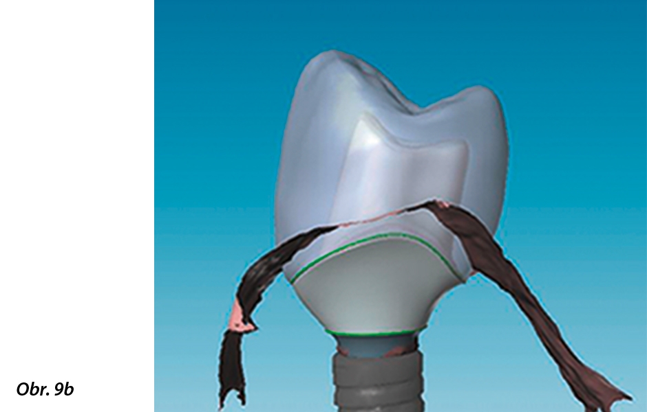 Ve frézovacím centru jsou modely skenovány a pomocí softwaru CARES Visual 8.0 speciálně vyškolení technici navrhují cervikální okraj abutmentu. V závislosti na materiálových požadavcích jsou abutment a korunka odpovídajícím způsobem dimenzovány.
