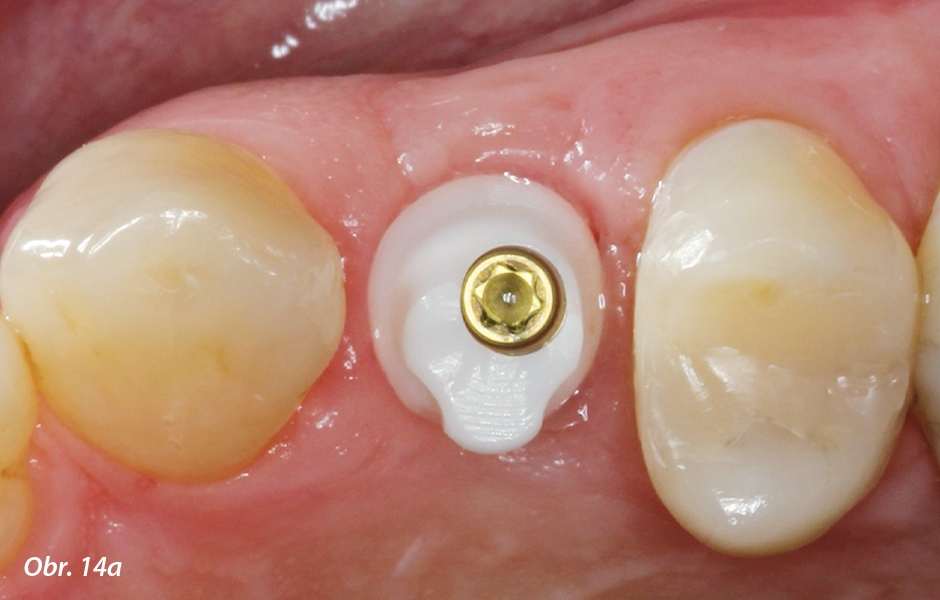 Zubní lékař a technik zvolili korunku fixovanou na cement vzhledem k mírně bukální orientaci osy implantátu (viz obr. 7b).