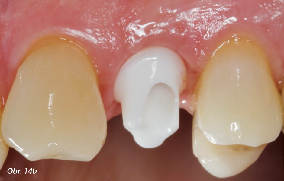 Zubní lékař a technik zvolili korunku fixovanou na cement vzhledem k mírně bukální orientaci osy implantátu (viz obr. 7b).
