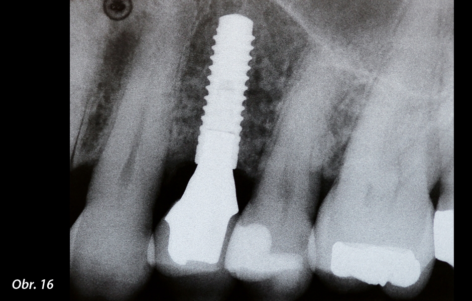 Rentgenový snímek jasně ukazuje, že okraj abutmentu je cirkulárně přizpůsoben úrovni gingivy.