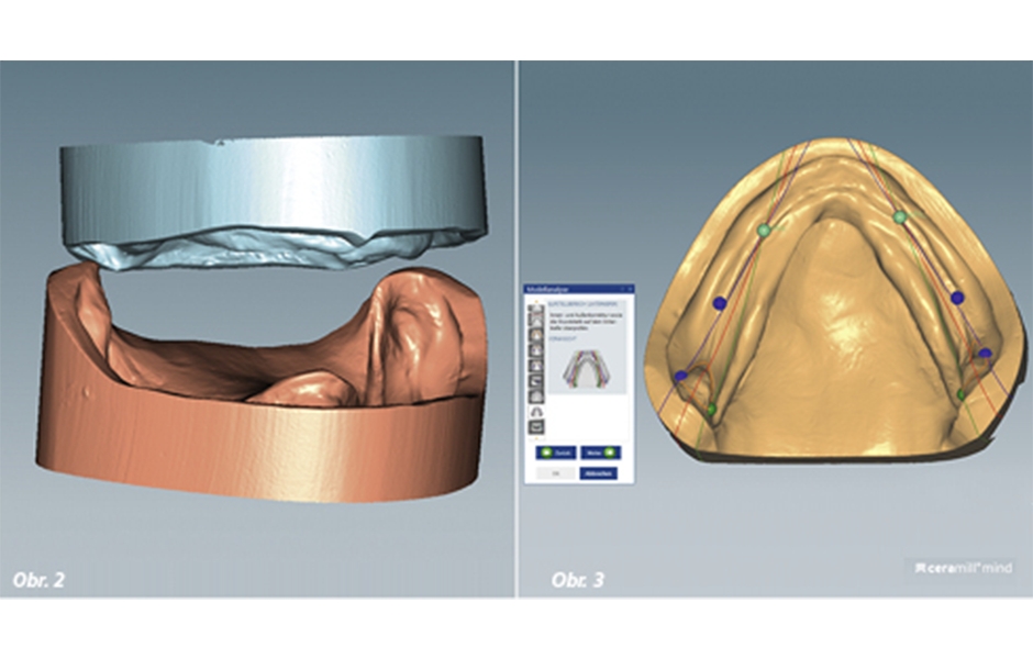 Obr. 2: Digitální model v klinicky zjištěném vertikálním vztahu Obr. 3: Analýza modelu provedená softwarem Ceramill Mind dle TiF