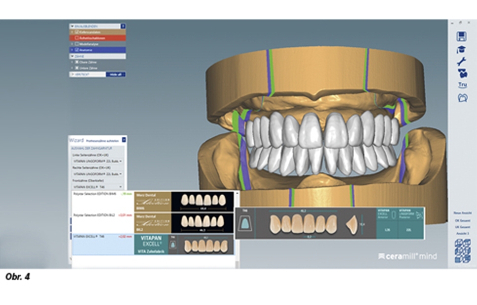 Obr. 4: Virtuální dosazení zubů po jejich výběru bylo provedeno stiskem tlačítka