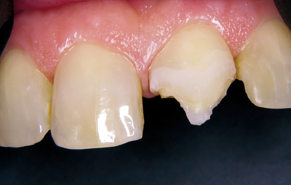 Obr. 6: Vyleptané tkáně zubu před aplikací adheziva.