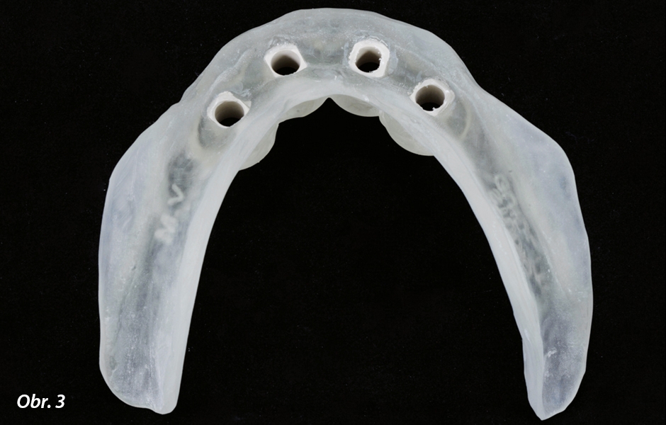 Dolní chirurgická šablona vyrobená z certifi kovaného plastového materiálu pro použití ve stomatologii. Do šablony je vloženo několik speciálních pouzder, které povedou pilotní vrtáčky při osteotomii a určí směr zavedení implantátu.