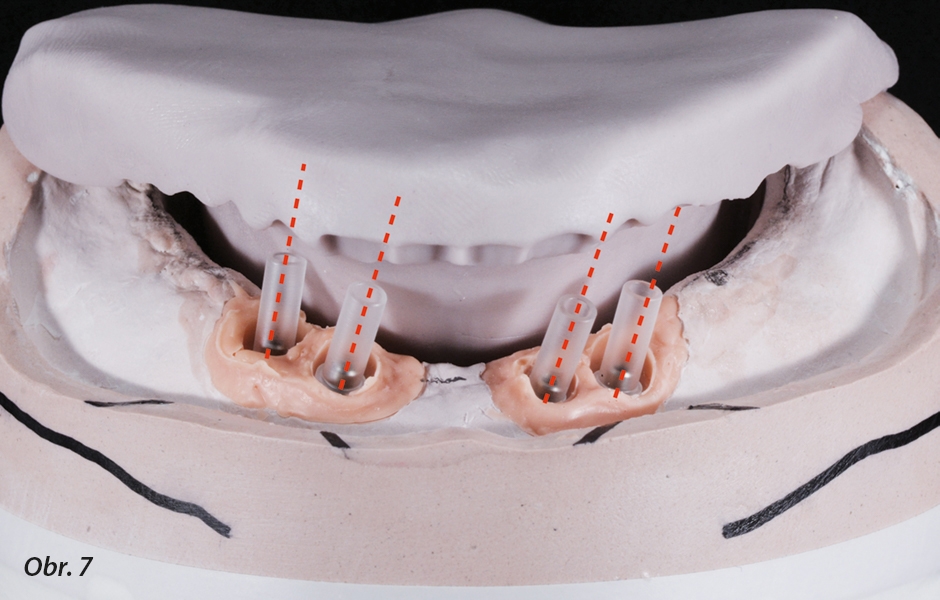 Značná rozbíhavost mezi implantáty způsobí problémy při nasazování třmenu – je vhodné u protetických komponent vyměnit vnitřní šestihran za vnější
