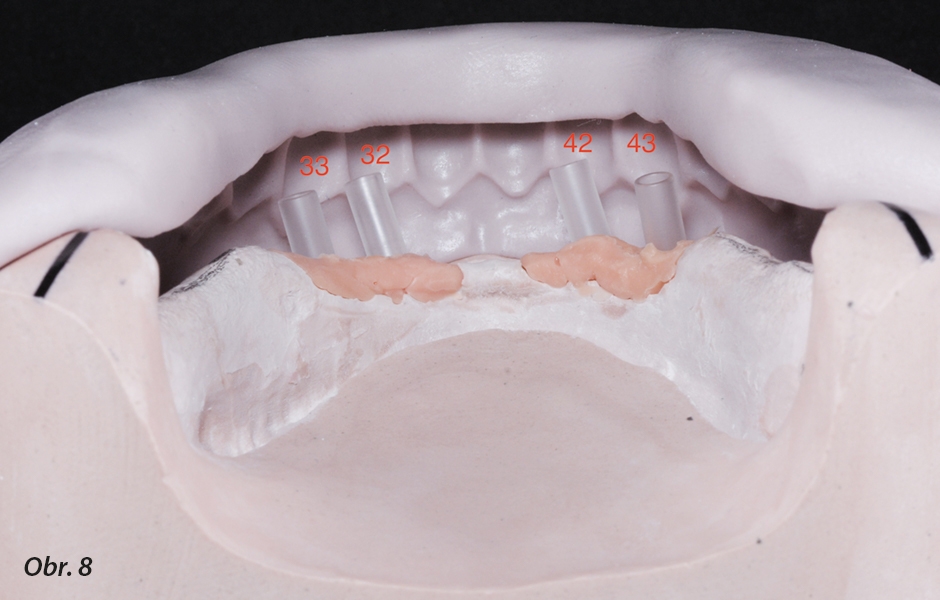 Čtyři implantáty ve frontální oblasti