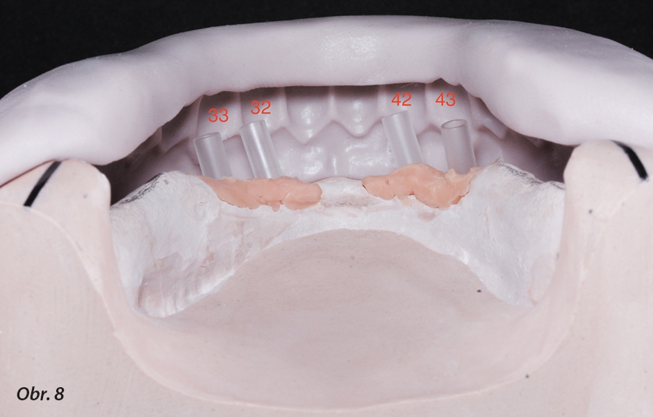 Čtyři implantáty ve frontální oblasti