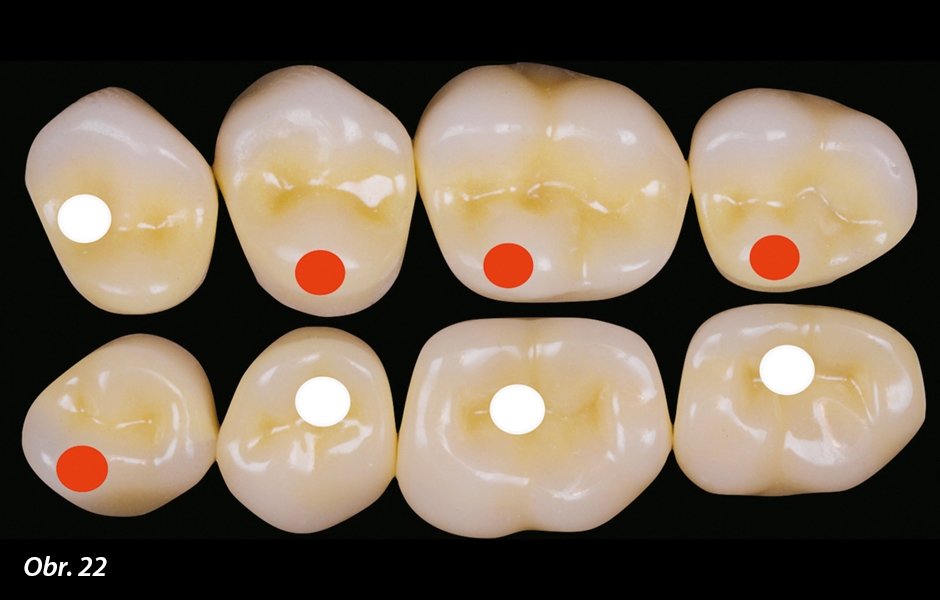 Lingvalizovaná okluze vysvětluje vztah mezi hrbolky a rýhami zubů. Prof. Gerber zpracoval teorii, že hroty hrbolků dolních zubů zapadají do rýh horních antagonistů.