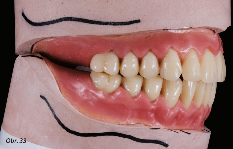 Diagnostický wax-up připravený na zkoušku v ústech. Wax-up umožní pacientce posoudit estetiku a rozměry náhrad. Meziálně nakloněný zub 37 a zuby v supraokluzi hovoří pro extrakci.