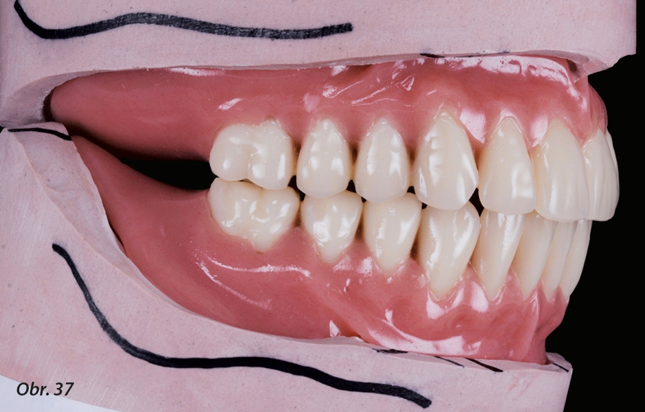 Hotové protézy na modelu, které posloužily k dalšímu vyhodnocení případu – zub 37 byl extrahován a třetí premolár byl nahrazen molárem