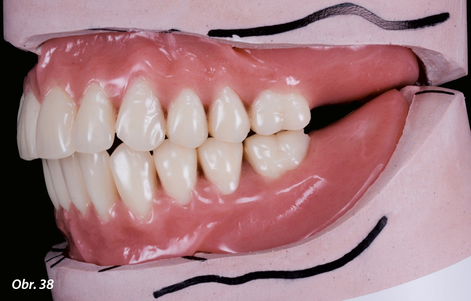 Hotové protézy na modelu, které posloužily k dalšímu vyhodnocení případu – zub 37 byl extrahován a třetí premolár byl nahrazen molárem