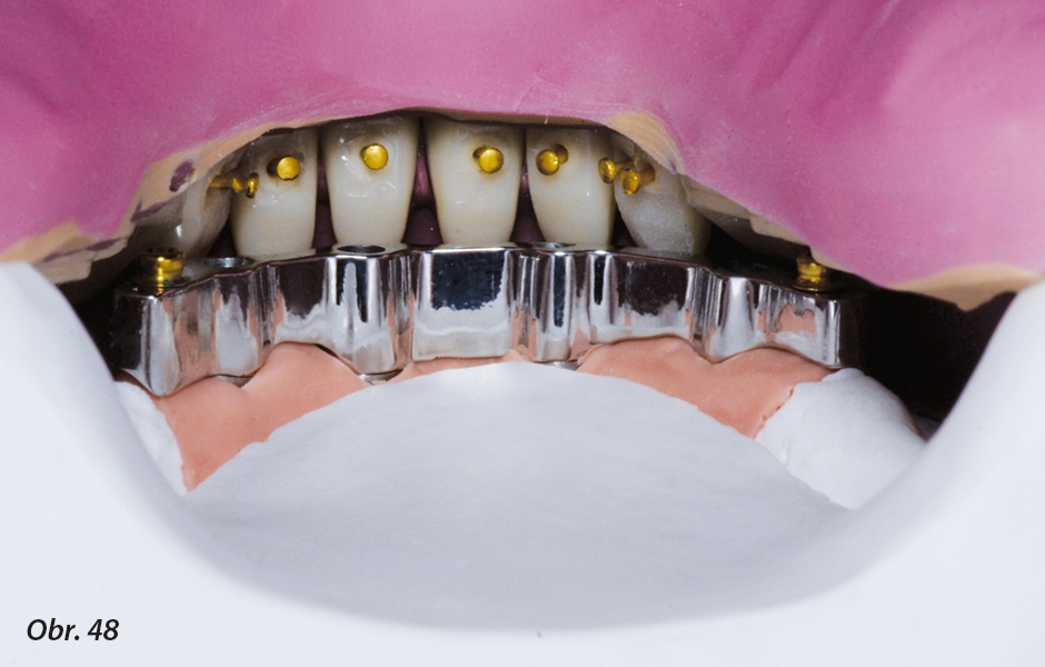 Se zuby umístěnými v klíči je možno vyhodnotit případné kolize a dostupný prostor.