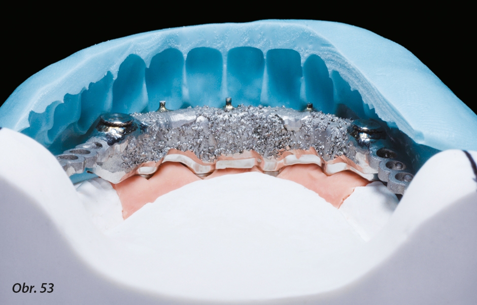 Kontrola dostatečného prostoru pro konfekční zuby pomocí silikonového klíče.