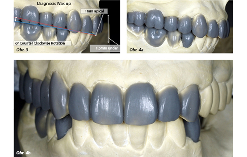 Obr. 3: Diagnostický wax-up. Obr. 4a–b: Přenos detailů z wax-upu na provizorní náhradu pomocí metody cross-mounting