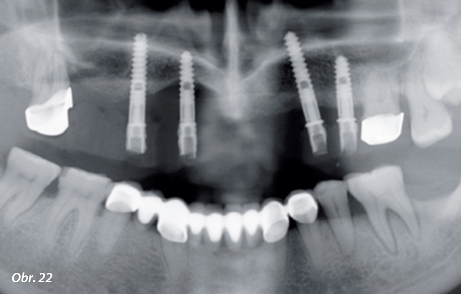 Materiál Juvora Dental Disc je vysoce čistý a bez aditiv, a není proto viditelný na rentgenu
