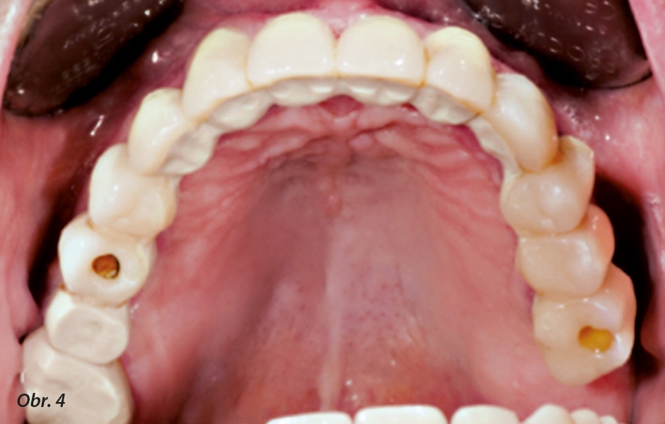 Můstek v ústech pacienta po 10 měsících in situ. Sekundární teleskopická korunka na zubu 26 a mezičlen můstku 25 byly navrženy plně anatomické. Odstín nefazetovaného PEEK (Juvora Dental Disc) je pro okluzální povrch v distálním úseku přijatelný. Stav ging
