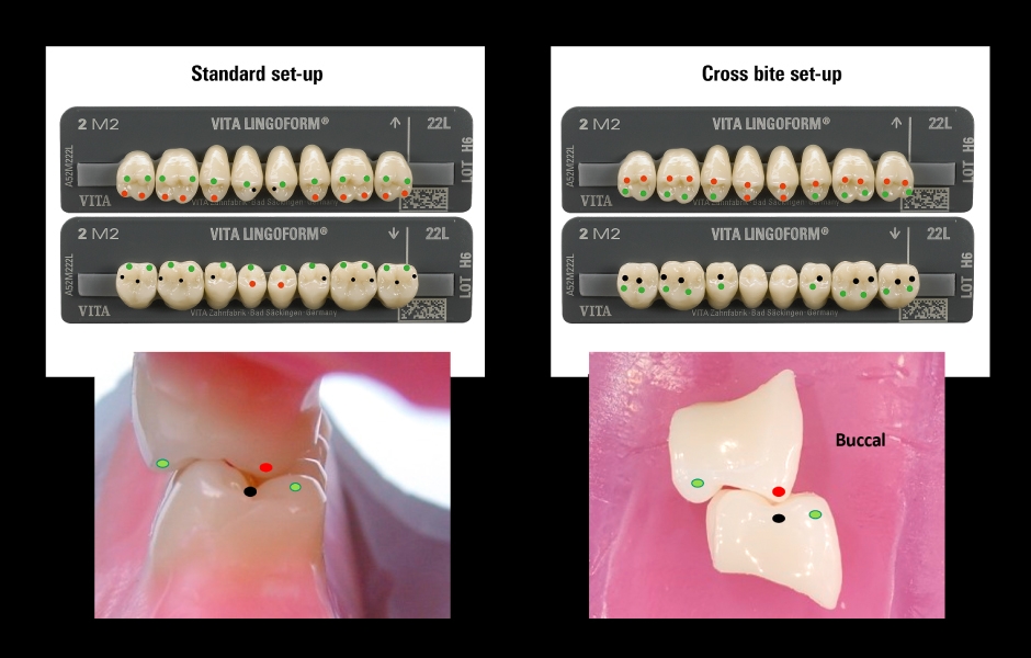 Obr. 3: Standardní sada zubů (vlevo). Sada zubů pro zkřížený skus (vpravo).