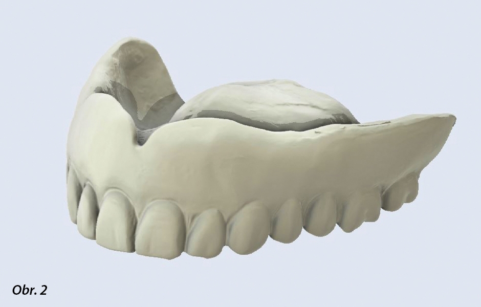 Sken snímatelné zubní náhrady pacienta v úhlu 360 ° pořízený intraorálním skenerem SHINING 3D – tento nový skener umožňuje bezdrátové barevné skenování