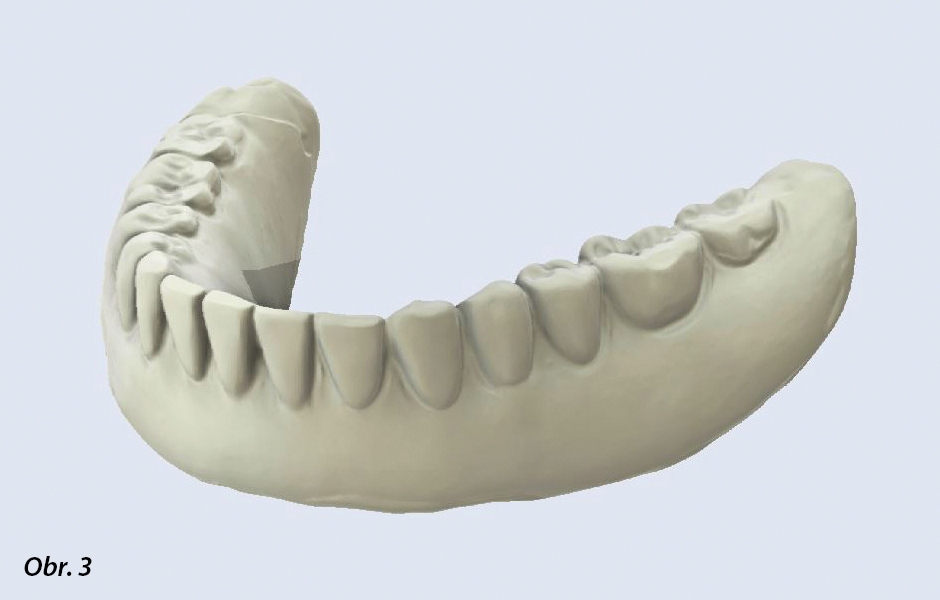 Sken snímatelné zubní náhrady pacienta v úhlu 360 ° pořízený intraorálním skenerem SHINING 3D – tento nový skener umožňuje bezdrátové barevné skenování