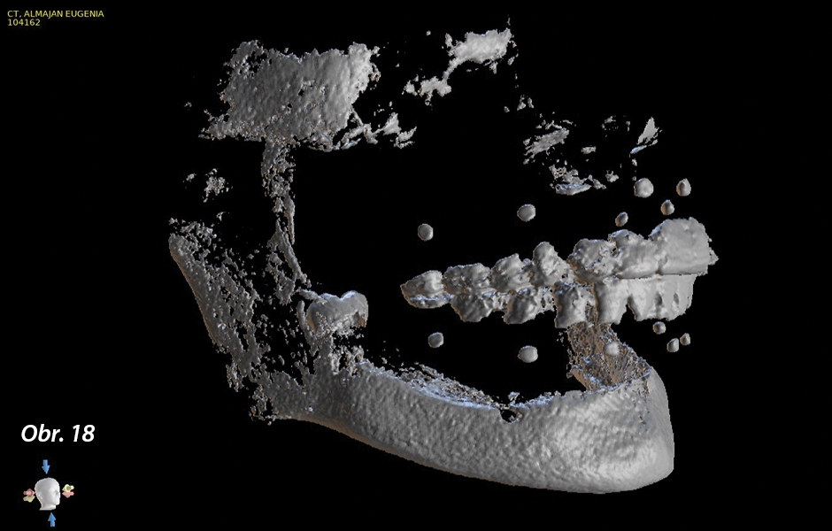 CBCT sken s nasazenými skenovacími šablonami; všimněte si základních referenčních značek a plošek zubů