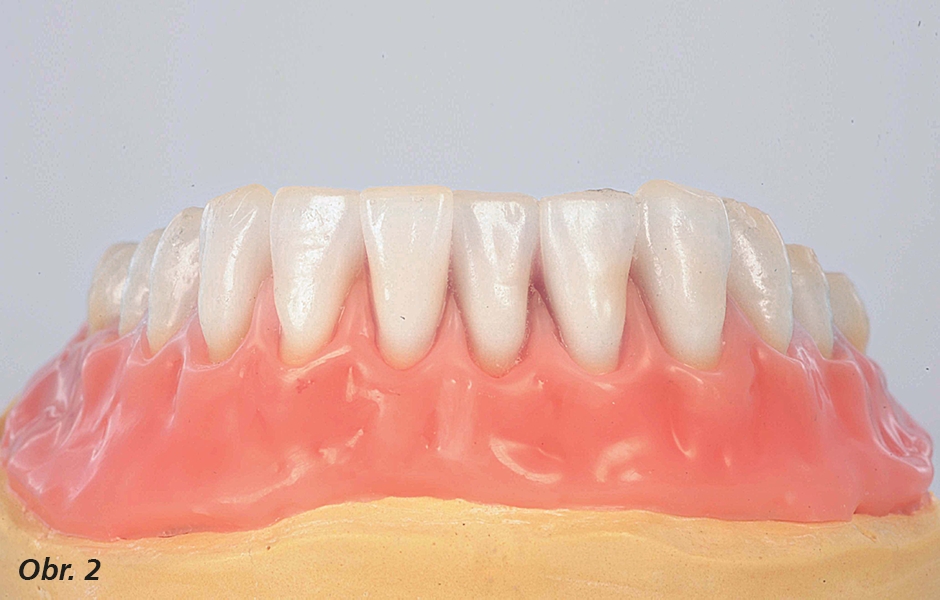 Po přípravě hlavního modelu a jeho umístění do artikulátoru se provádí výstavba zubů zaměřená na estetiku a funkci bez začlenění zřetele na pozici a typ implantátů